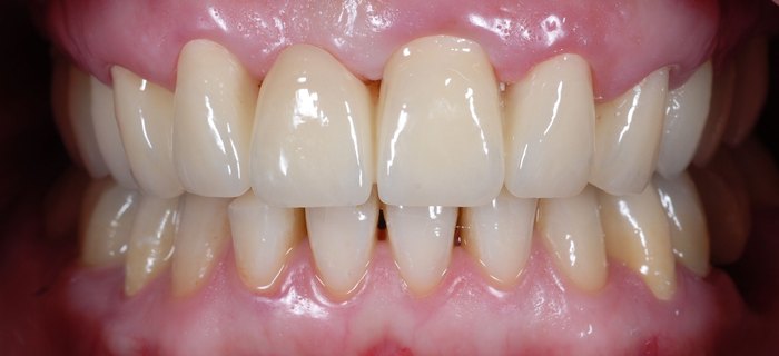 Zahn - Komplettsanierung in der Zahnarztpraxis Michalides & Lang ind Bremen - Stuhr
